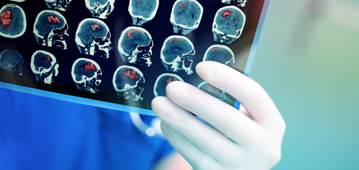 A THC elősegíti a traumás agyi sérülésből való felépülést